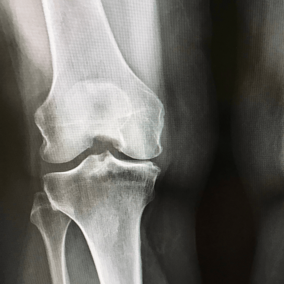 Understanding the First Steps to Knee Osteoarthritis Diagnosis and Management - My Cold Therapy 